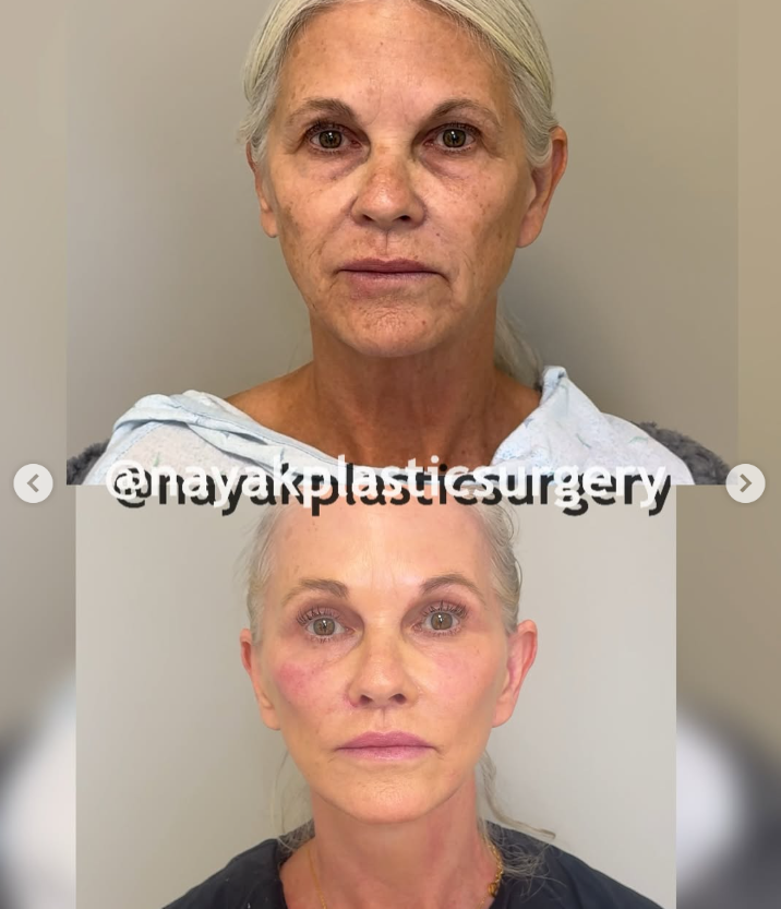 Lisa's before and after pictures, from a post dated April 4, 2025 | Source: Instagram/nayakplasticsurgery