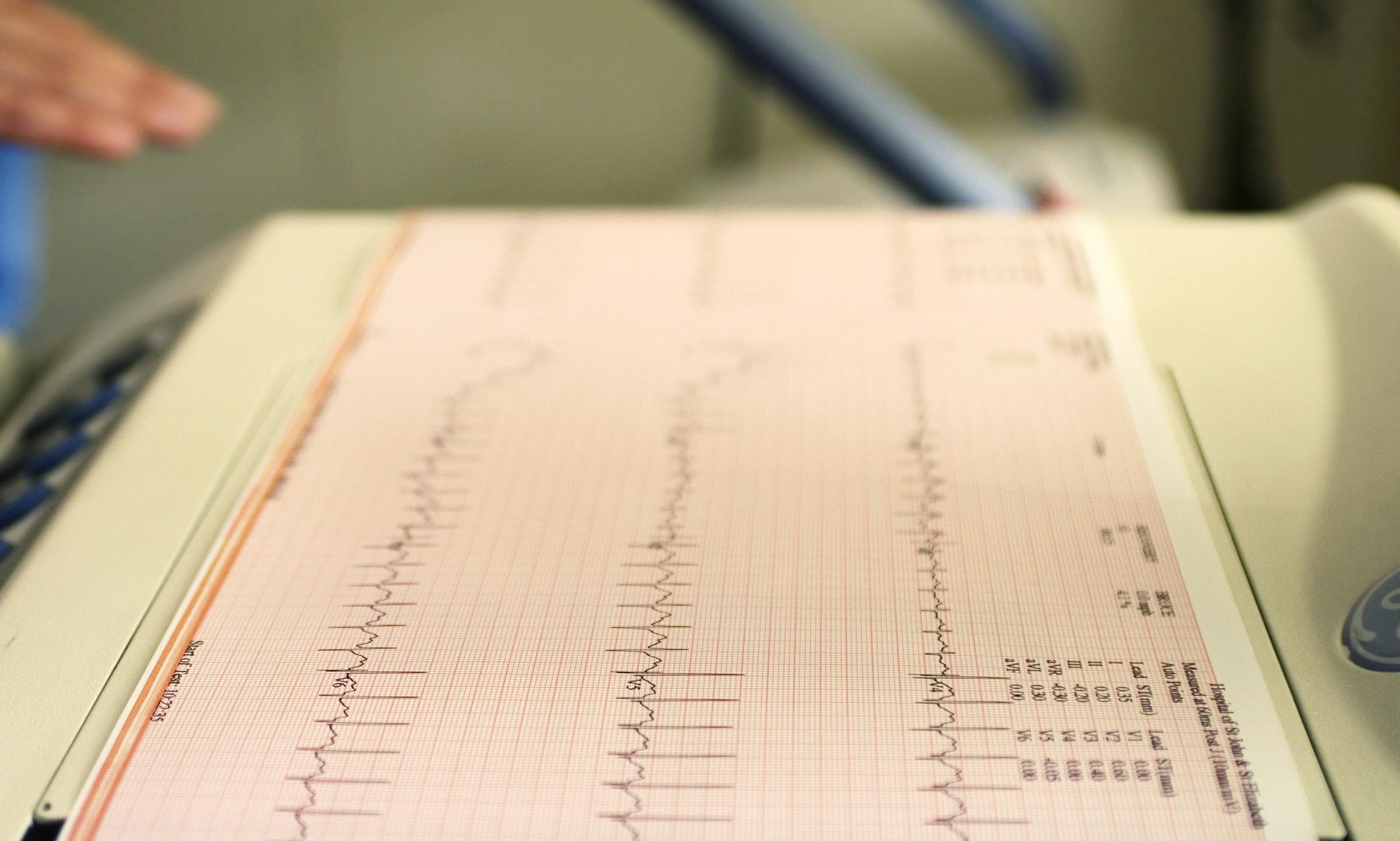 Electrocardiogram recording of patients cardiac cycle produced by electrocardiograph | Source: Getty Images