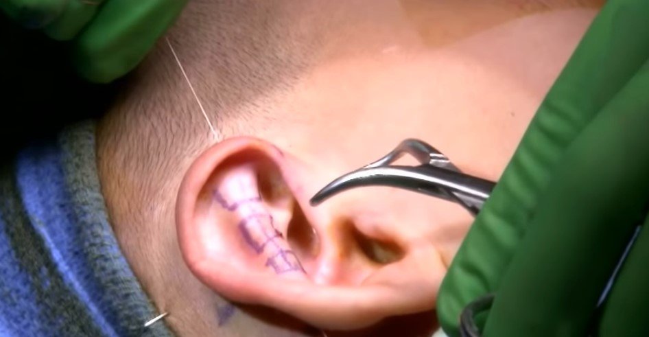 Picture of Gage's ear during the surgery. | Source: Youtube/Inside Edition  
