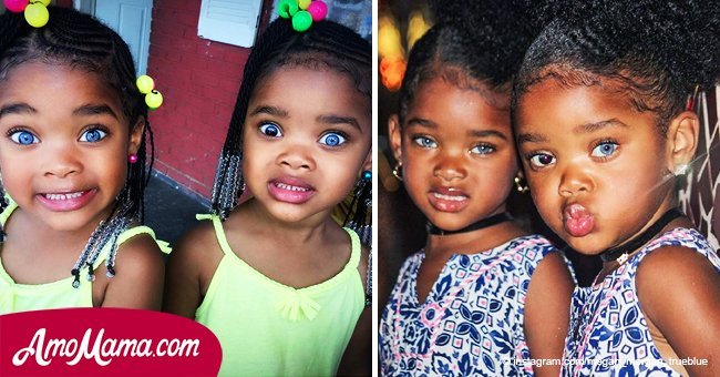 These twin girls became famous because of their unique eye color. Heres how they look today