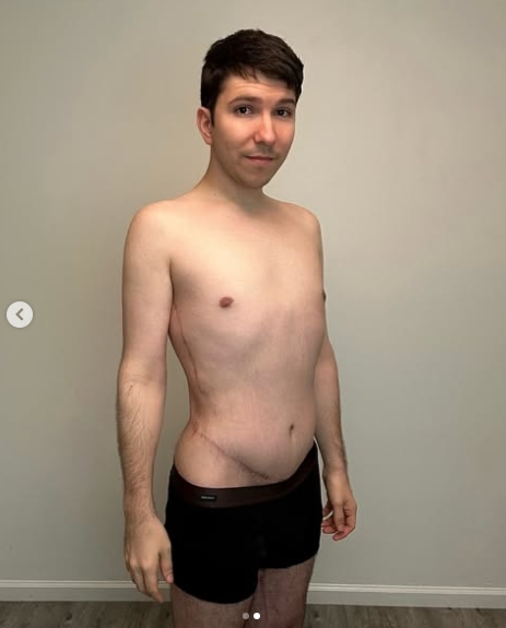 In a post dated October 11, 2025, Nikocado Avocado showed off his slimmer physique more than a year after revealing his secret 250-pound weight loss, giving followers another look at the dramatic transformation that had stunned millions when it was first unveiled. | Source: Instagram/real_nikocado