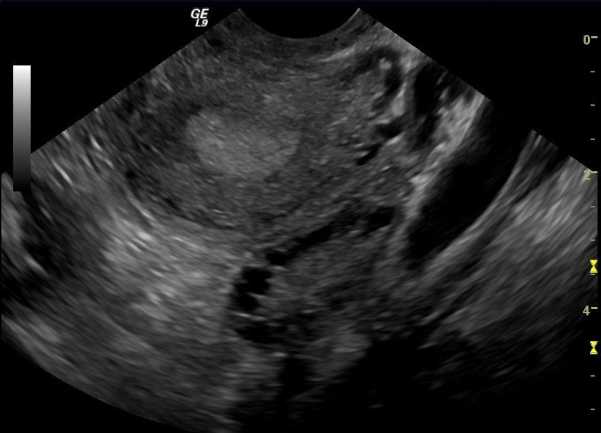 Radiografía de ovarios. | Imagen: Wikimedia Commons