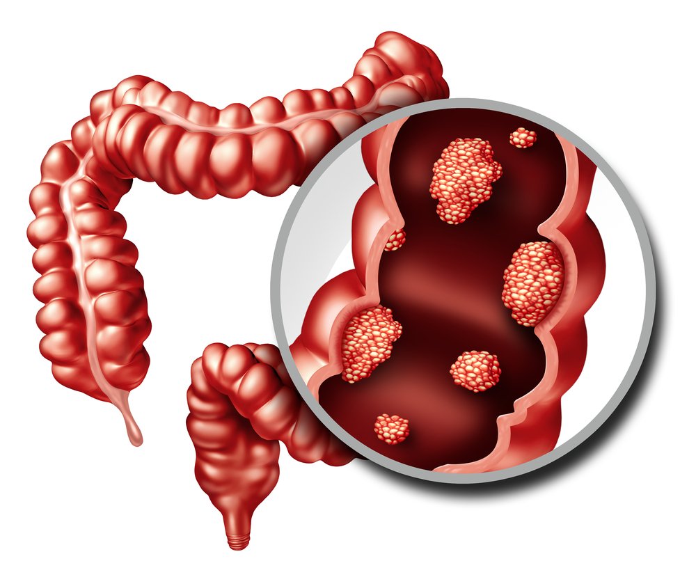cancer colorectal / Source : Shutterstock cancer colorectal / Source : Shutterstock