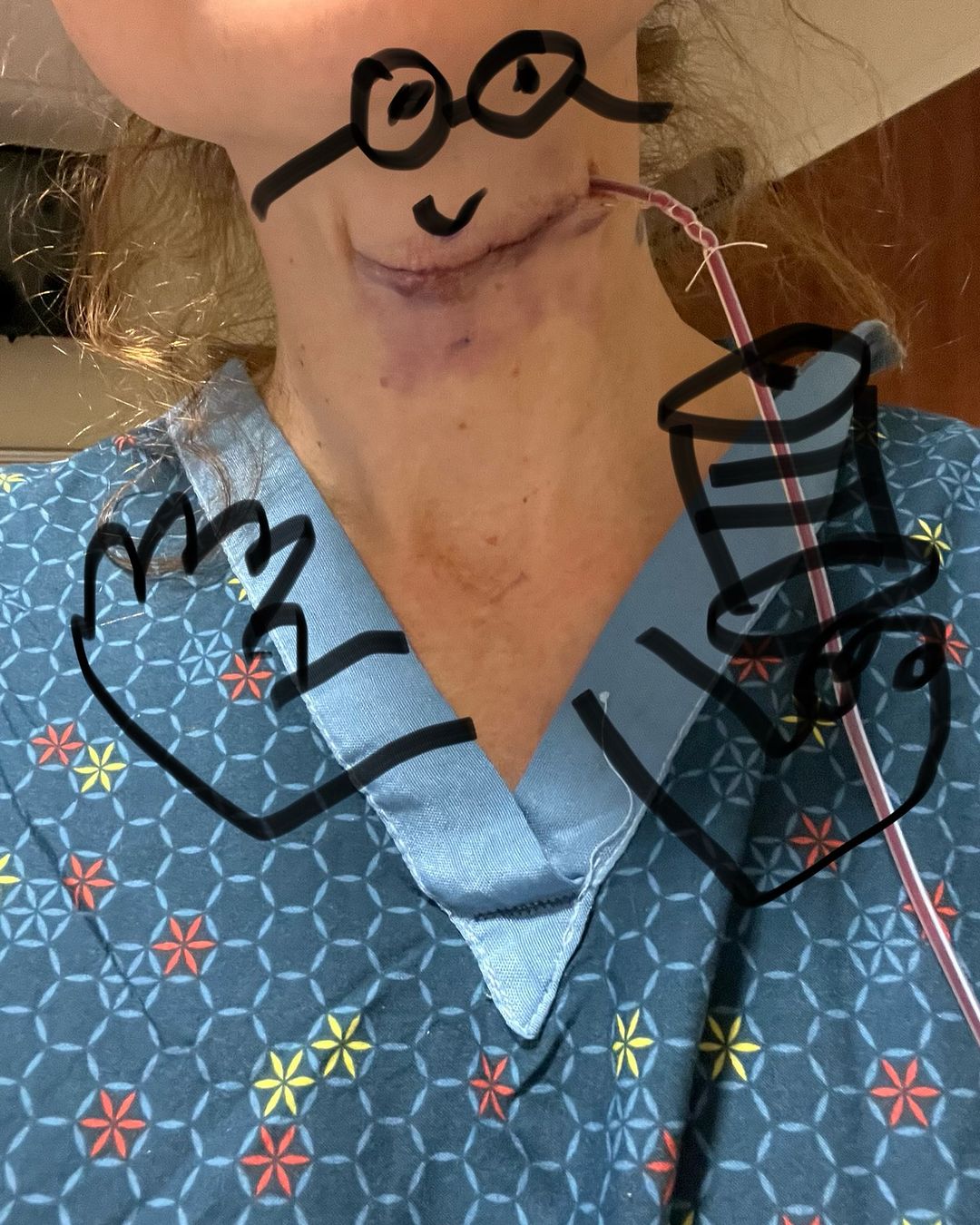 Kimberly Paisley shows the drawing her brother did on the picture of her scar from her laryngoplasty surgery, on a post dated August 18, 2024 | Source: Instagram/kimberlywilliamspaisley/