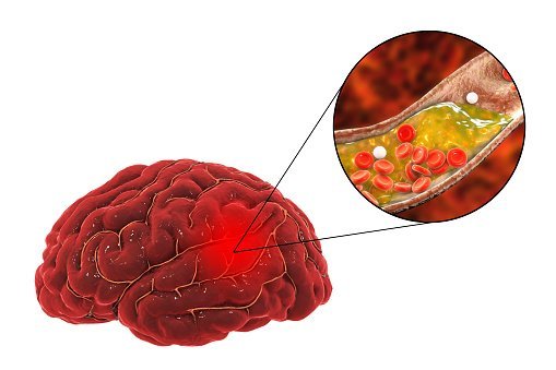 Blood Clot that leads to Stroke | Photo: Getty Images