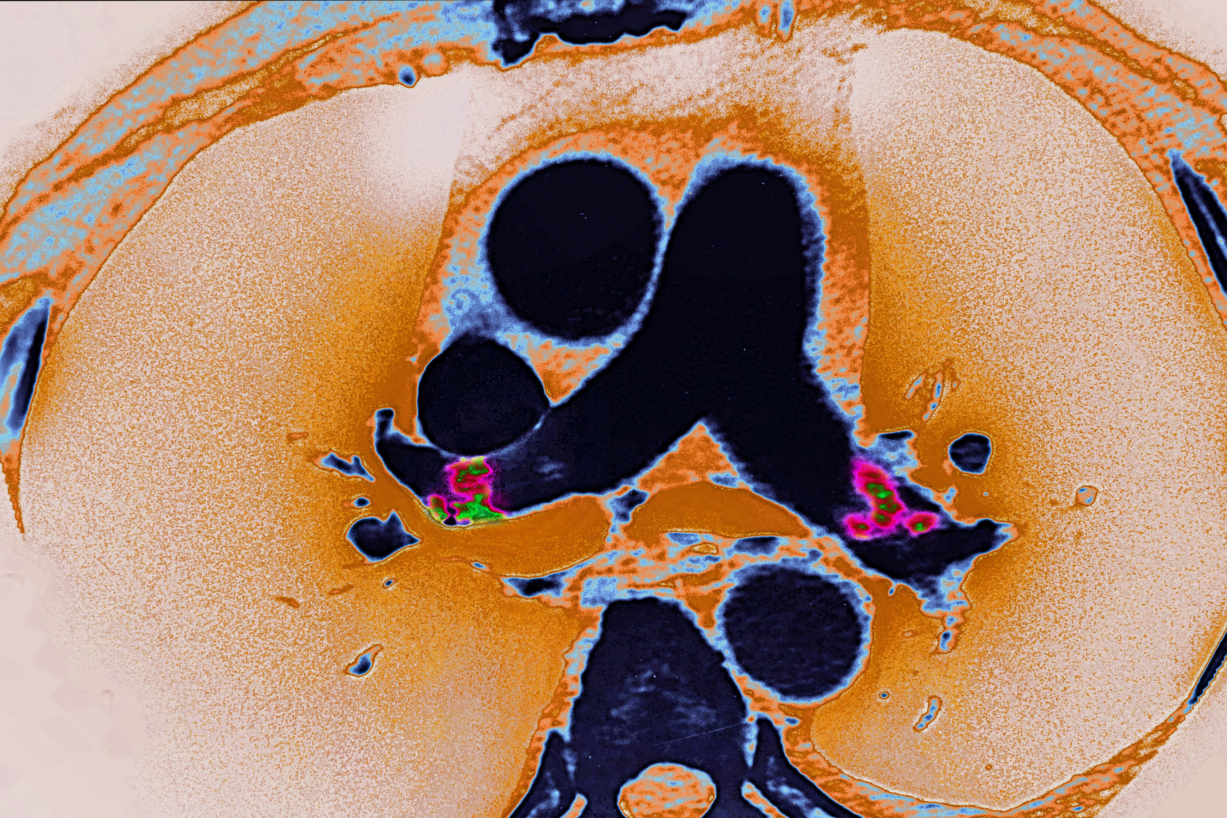Pulmonary embolism in the left and right pulmonary arteries, seen on a radial section chest CT scan. | Source: Getty Images