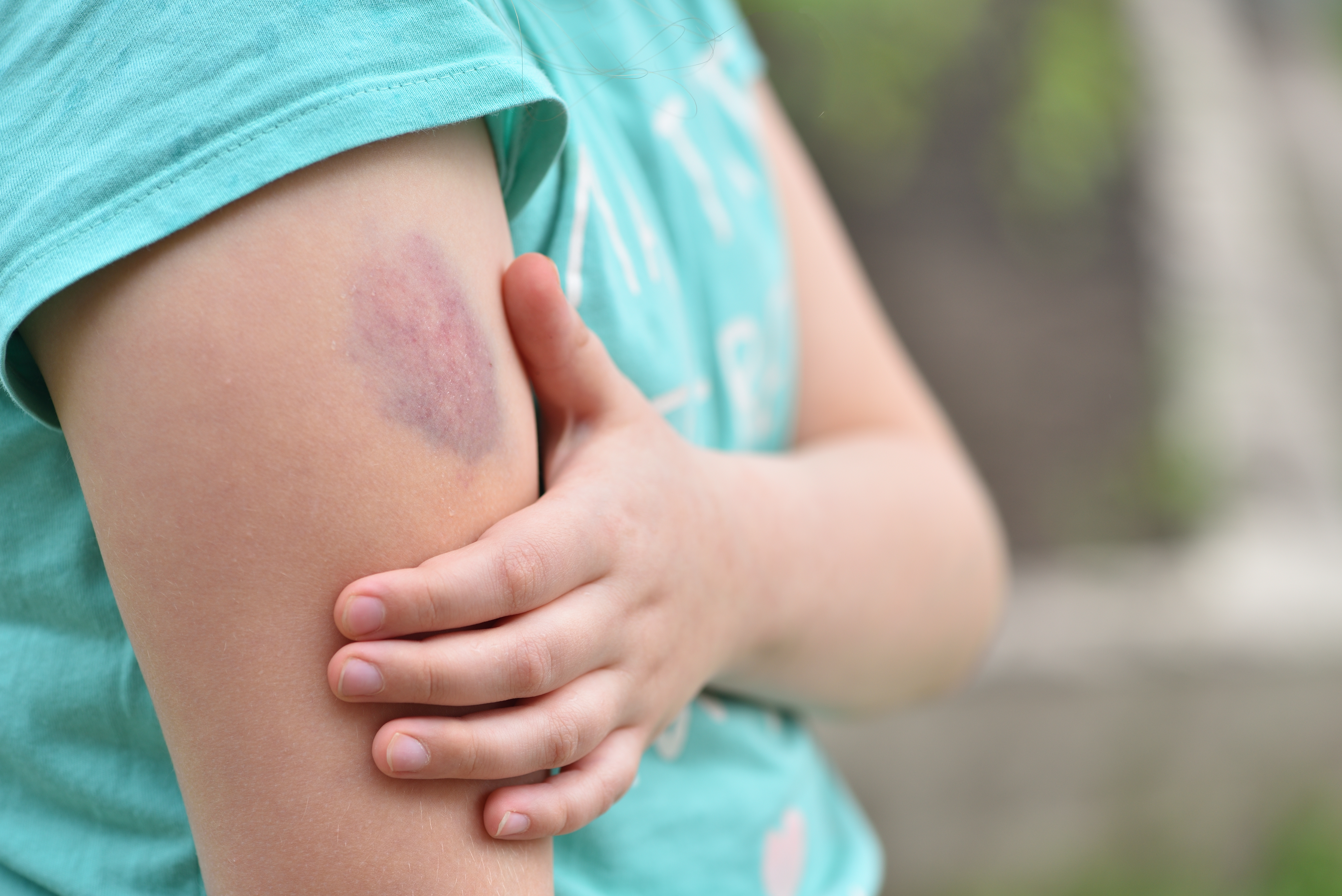 Bruises | Source: Shutterstock