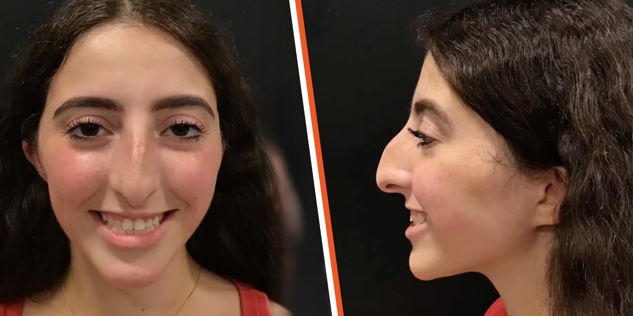 A patient before rhinoplasty | Source: Instagram/drkassir