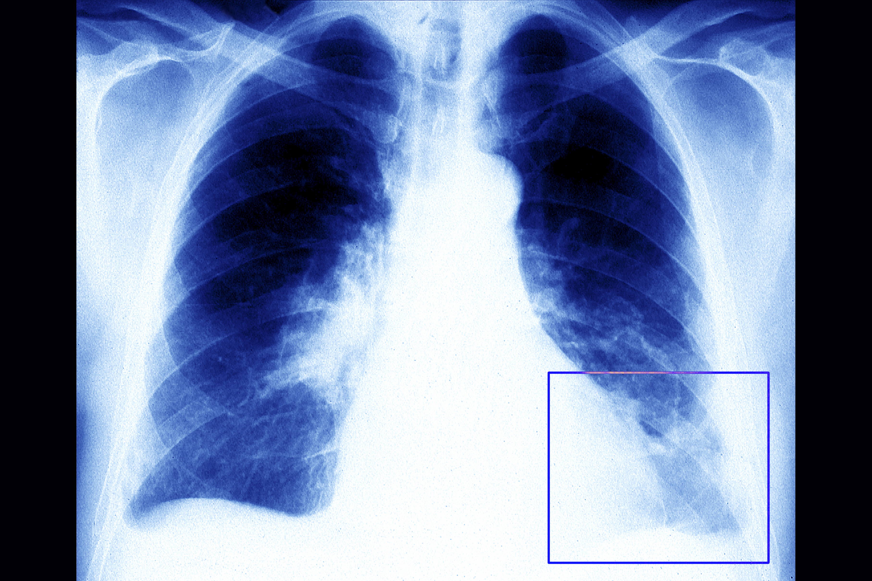 Frontal chest X-ray showing a pulmonary embolism: a blood clot located in the left lower lobe of the lung. | Source: Getty Images