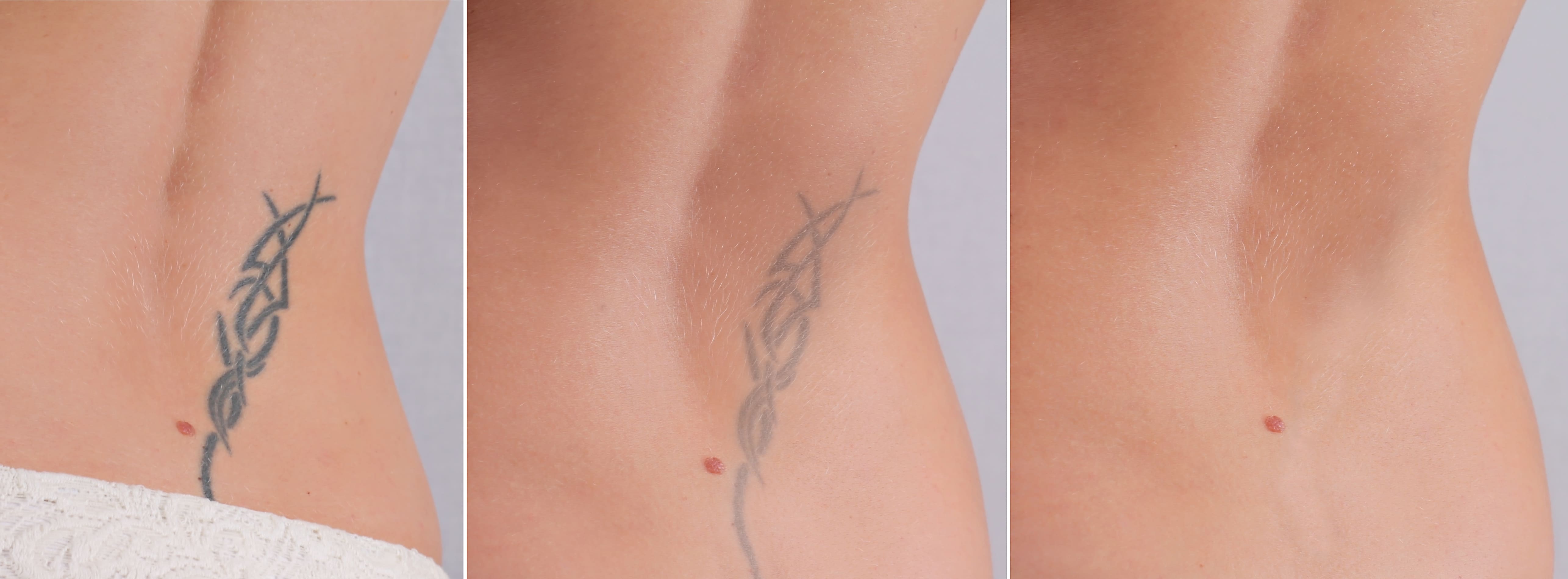 Tattoo removal | Shutterstock