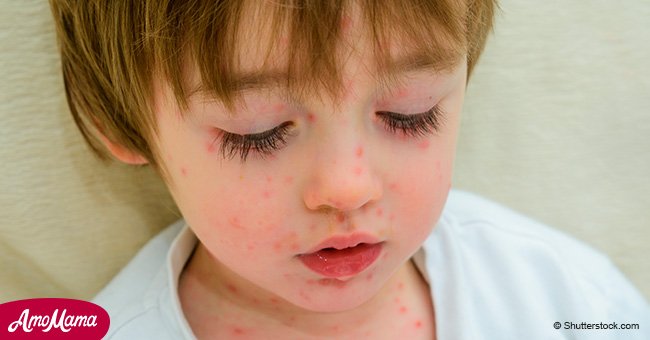 Baby suffers stroke after being exposed to chicken pox through unvaccinated sibling