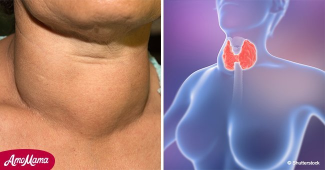 First 4 hidden warning signs of thyroid cancer which a lot of people ignore, according to doctor