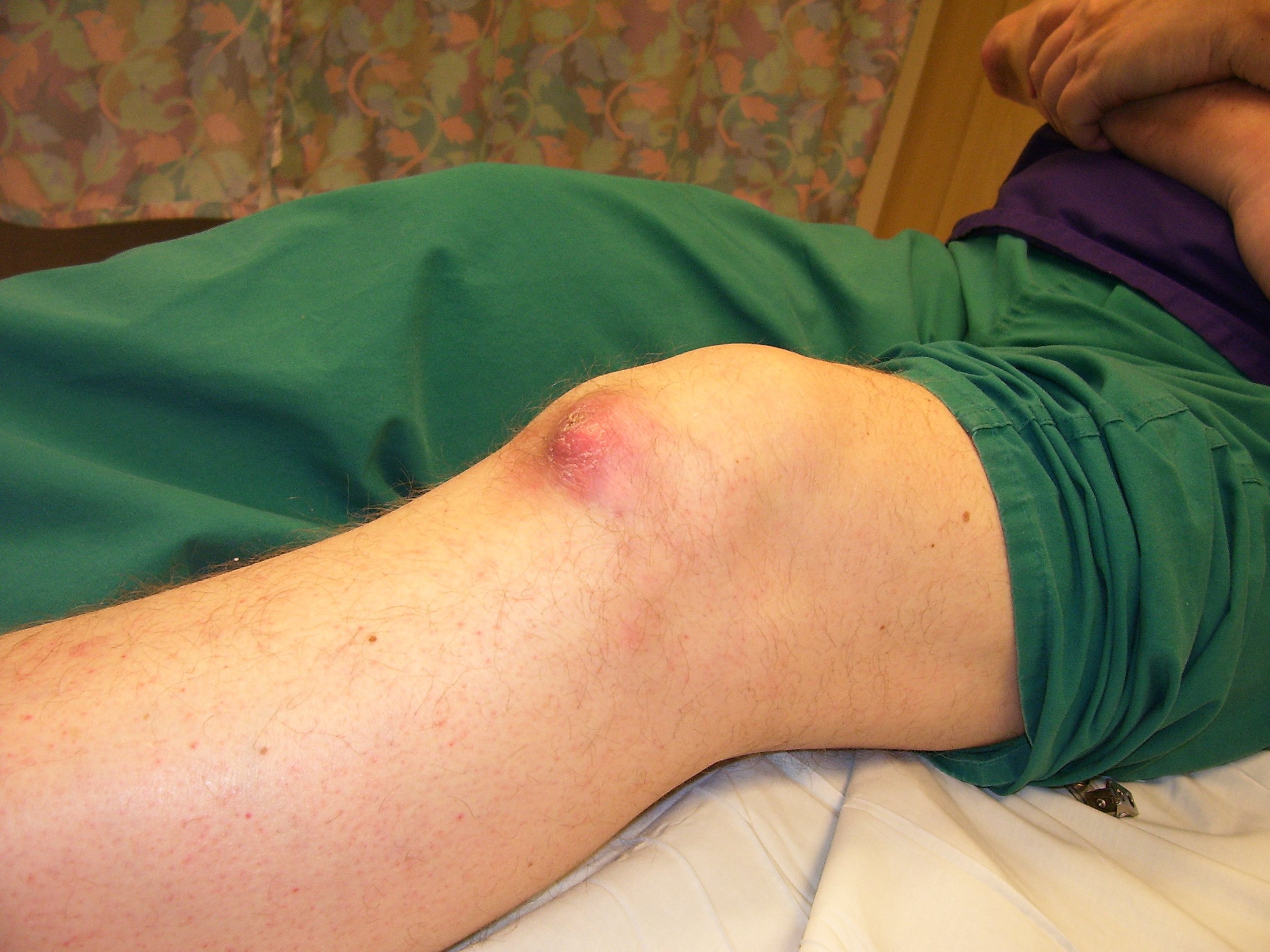 Tofo gotoso en rodilla. Fuente: Wikimedia Commons Tofo gotoso en rodilla. Fuente: Wikimedia Commons