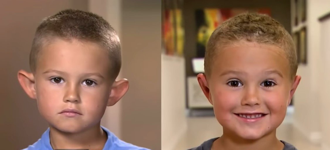 Picture of six-year-old Gage Berger before and after the surgery. | Source: Youtube/Inside Edition 
