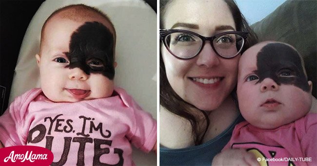 Baby born with large facial birthmark dubbed a 'little superhero'