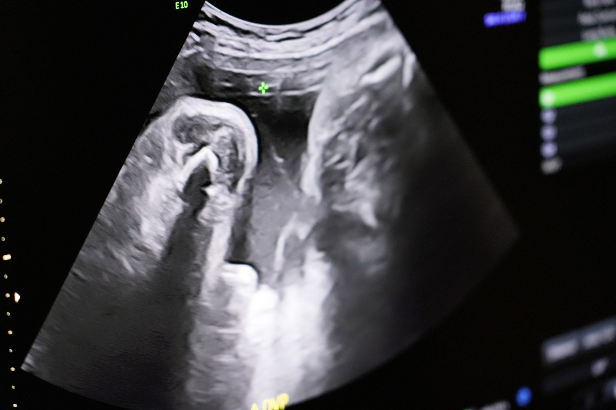 Fetal ultrasound image from Shelly Battista's pregnancy, taken during a medical exam, dated January 12, 2023 | Source: Facebook/northwesternmedicine