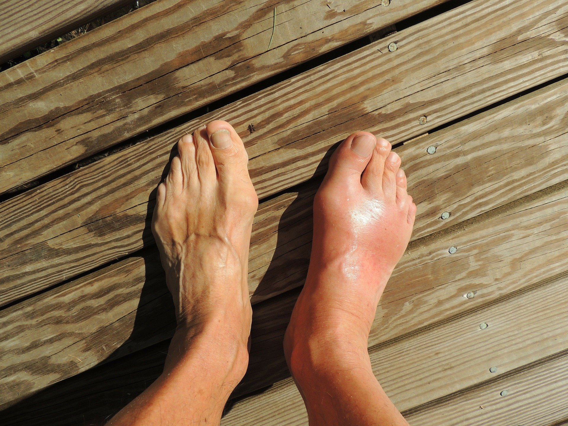 Geschwollene Füße | Quelle: Pixabay