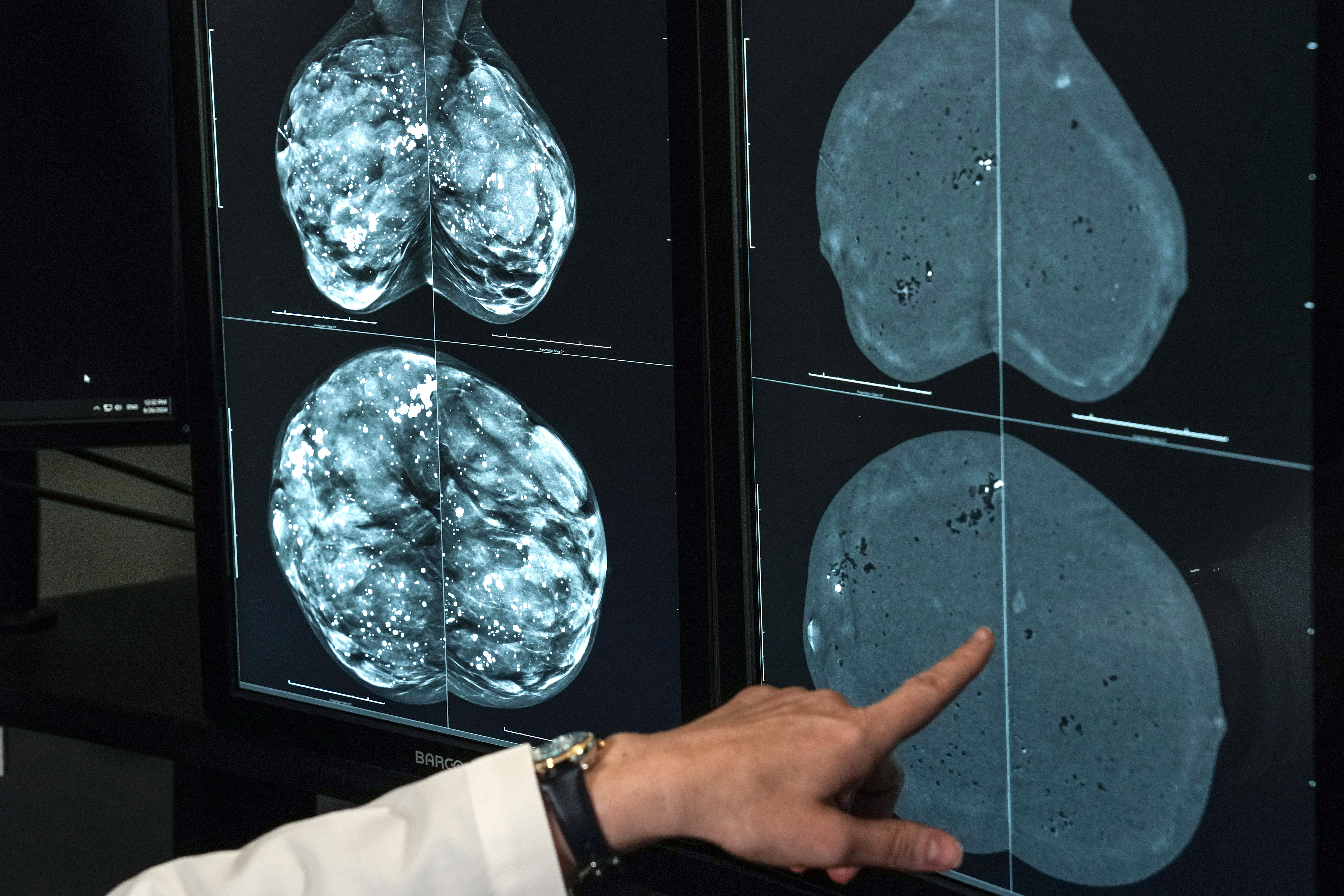 Dr. Olena Weaver looks at mammogram imagery on September 26, 2024, in Houston | Source: Getty Images
