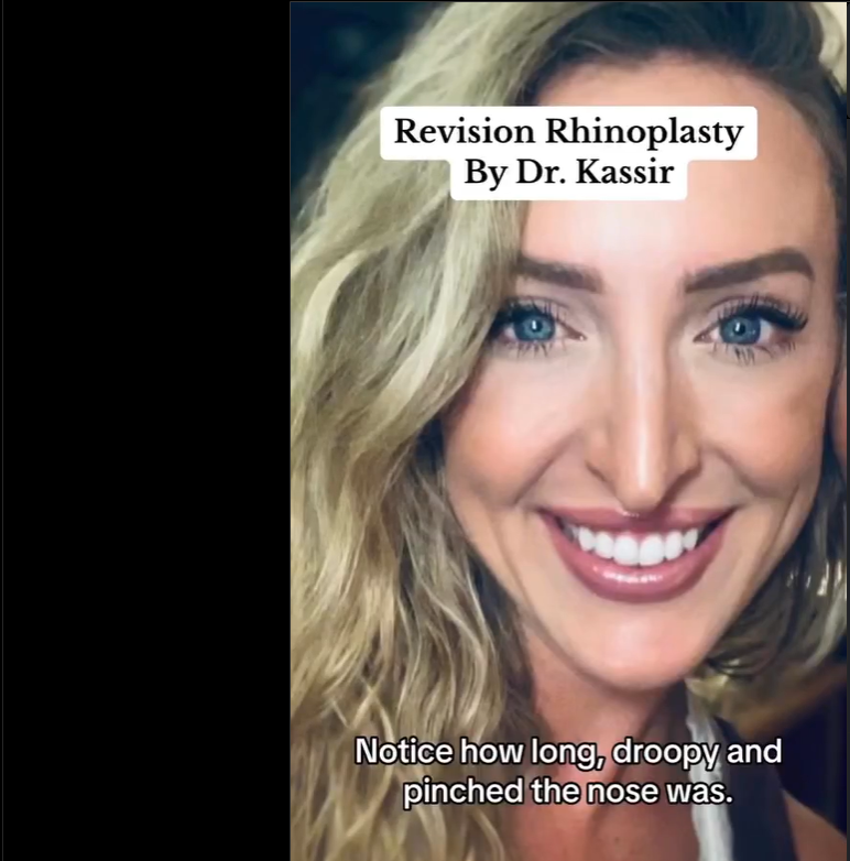 Patient before the revision procedure, dated August 26, 2023 | Source: Instagram/drkassir