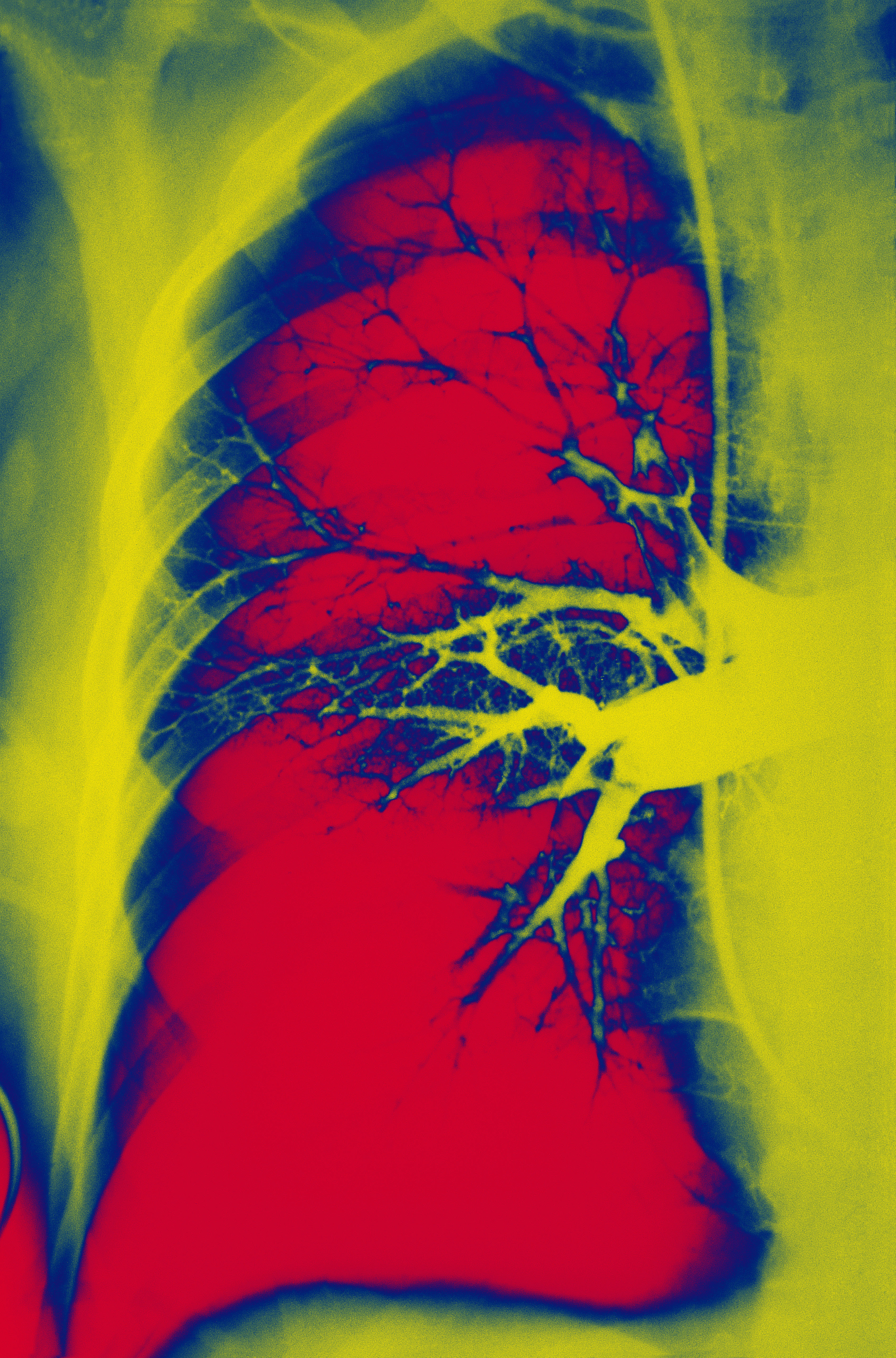 An X-ray image showing a pulmonary embolism, a sudden blockage of the pulmonary artery or one of its branches by a blood clot. | Source: Getty Images