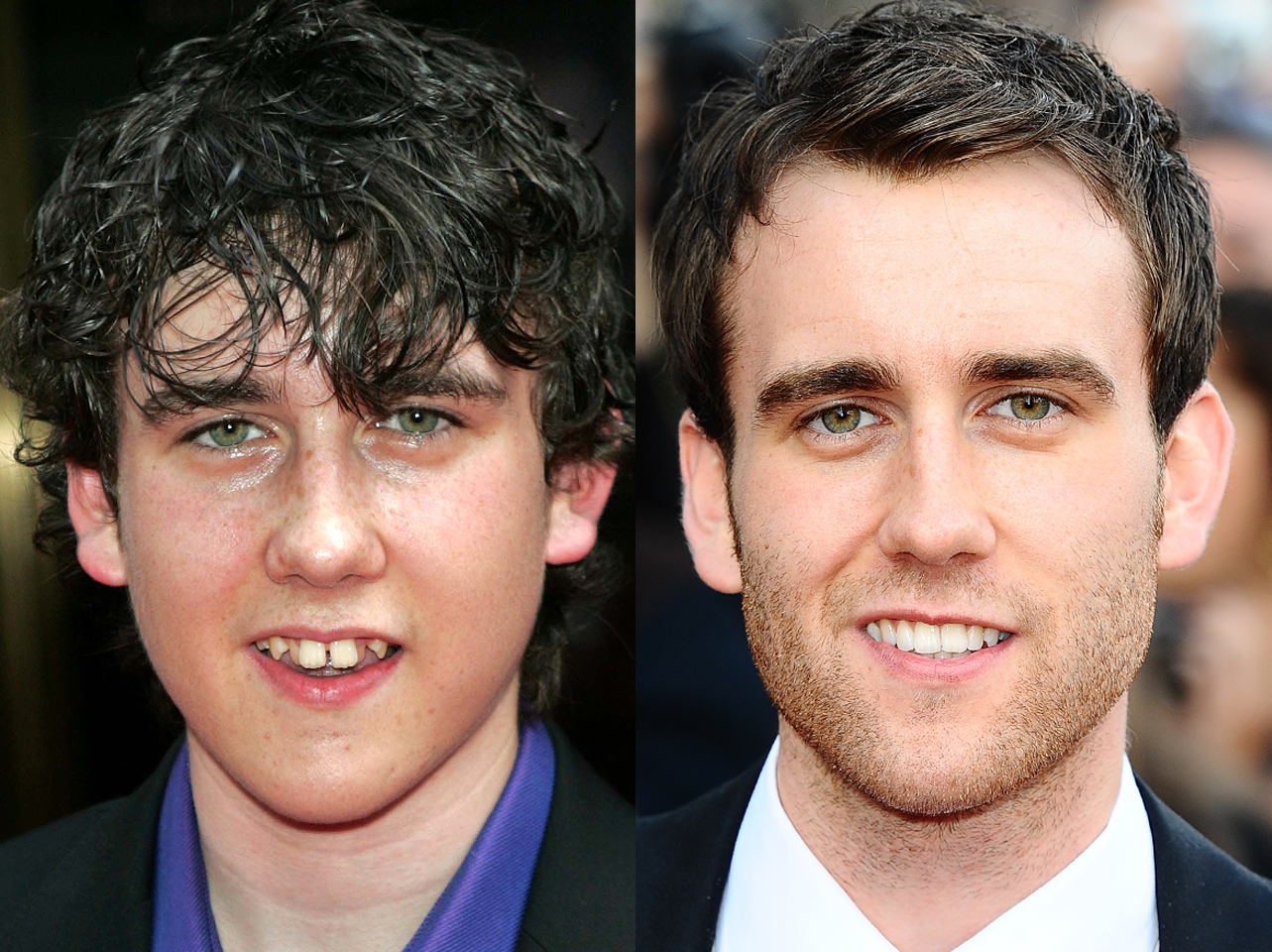A before and after of Matthew Lewis' smile. | Source: Getty Images