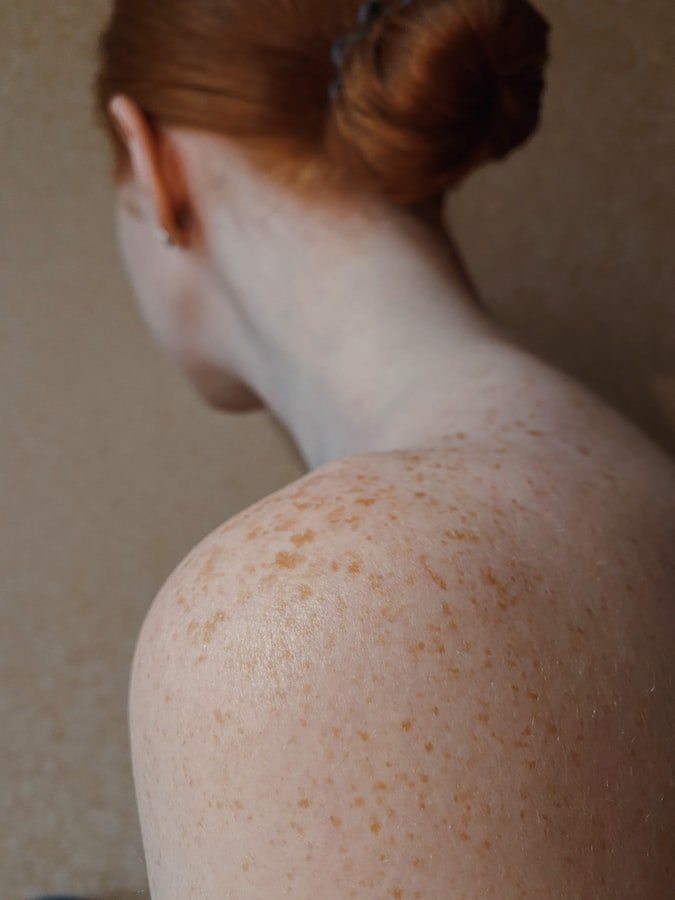 Une femme avec des taches de rousseur. l Source : Unsplash