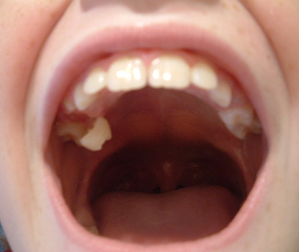 Boca abierta con molar desprendiéndose de la encía. | Imagen: Flickr Boca abierta con molar desprendiéndose de la encía. | Imagen: Flickr