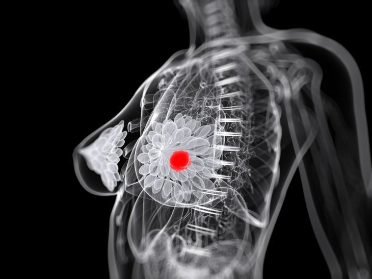 Coupe radiographique d'un sein atteint d'un cancer. | Getty Images/GlobalImagesofUkraine