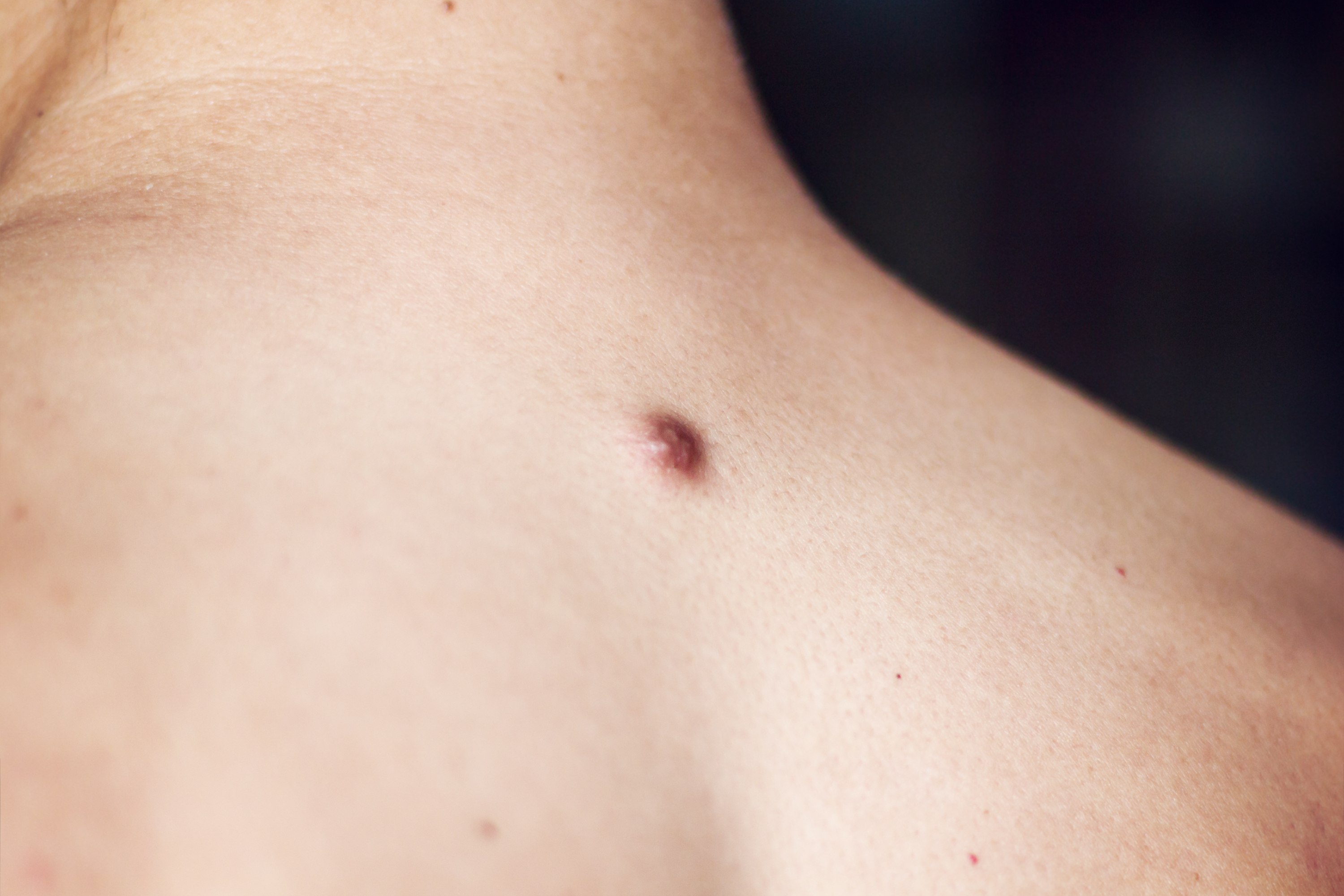 Dark pimple on the back. | Source: Shutterstock