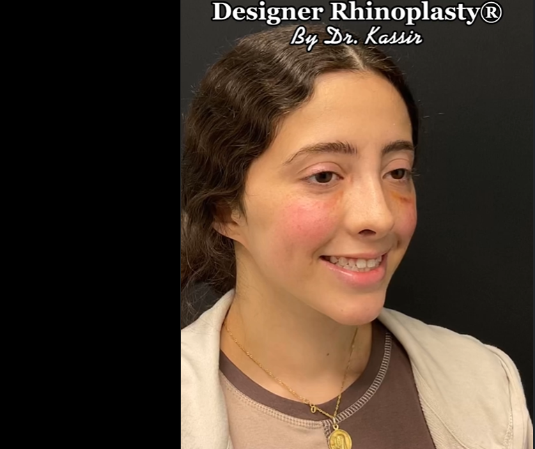 Patient after rhinoplasty, dated June 15, 2022 | Source: Instagram/drkassir