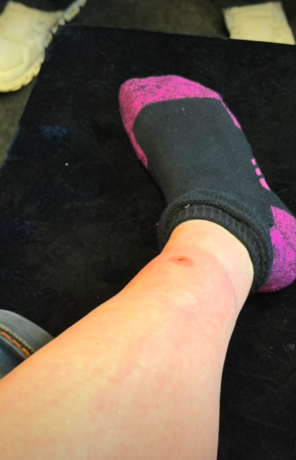 A close-up of the red mark on Taylor Momsen's leg. | Source: Instagram/taylormomsen