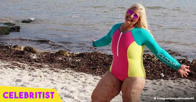 Woman who lost 350 pounds body shamed on the beach even after skin removal surgery