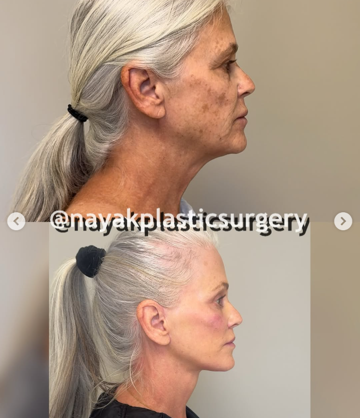 Lisa's before and after pictures, from a post dated April 4, 2025 | Source: Instagram/nayakplasticsurgery