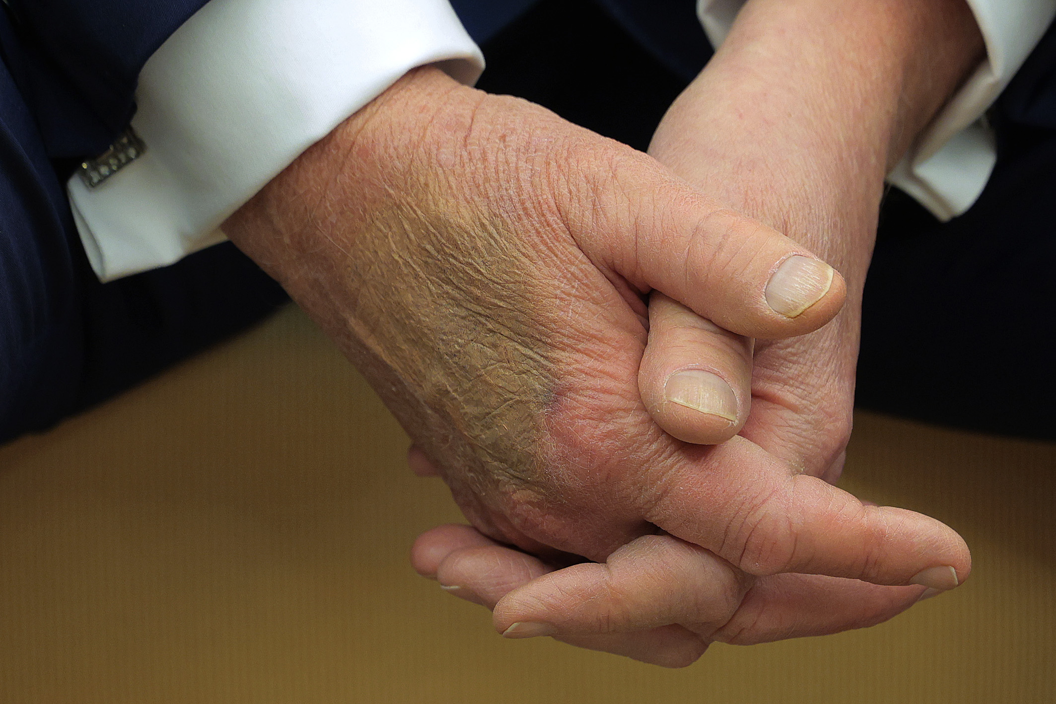 Makeup covers a bruise on the back of Donald Trump's hand as he hosts French President Emmanuel Macron for meetings at the White House on February 24, 2025 in Washington, DC | Source: Getty Images