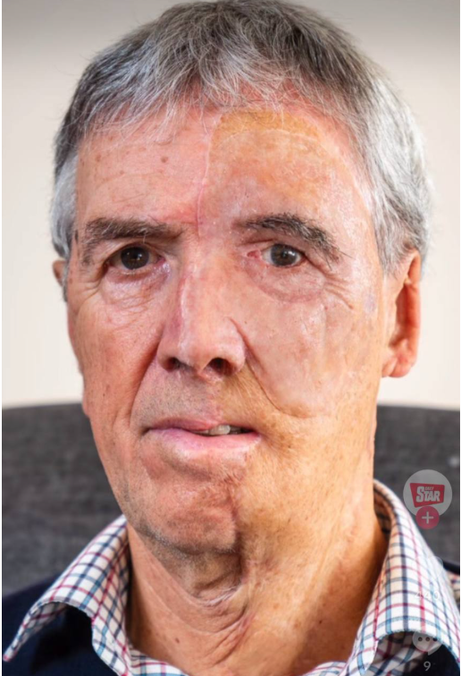 Dave Richards wearing his prosthetic face | Source: TikTok/TheDailyStar