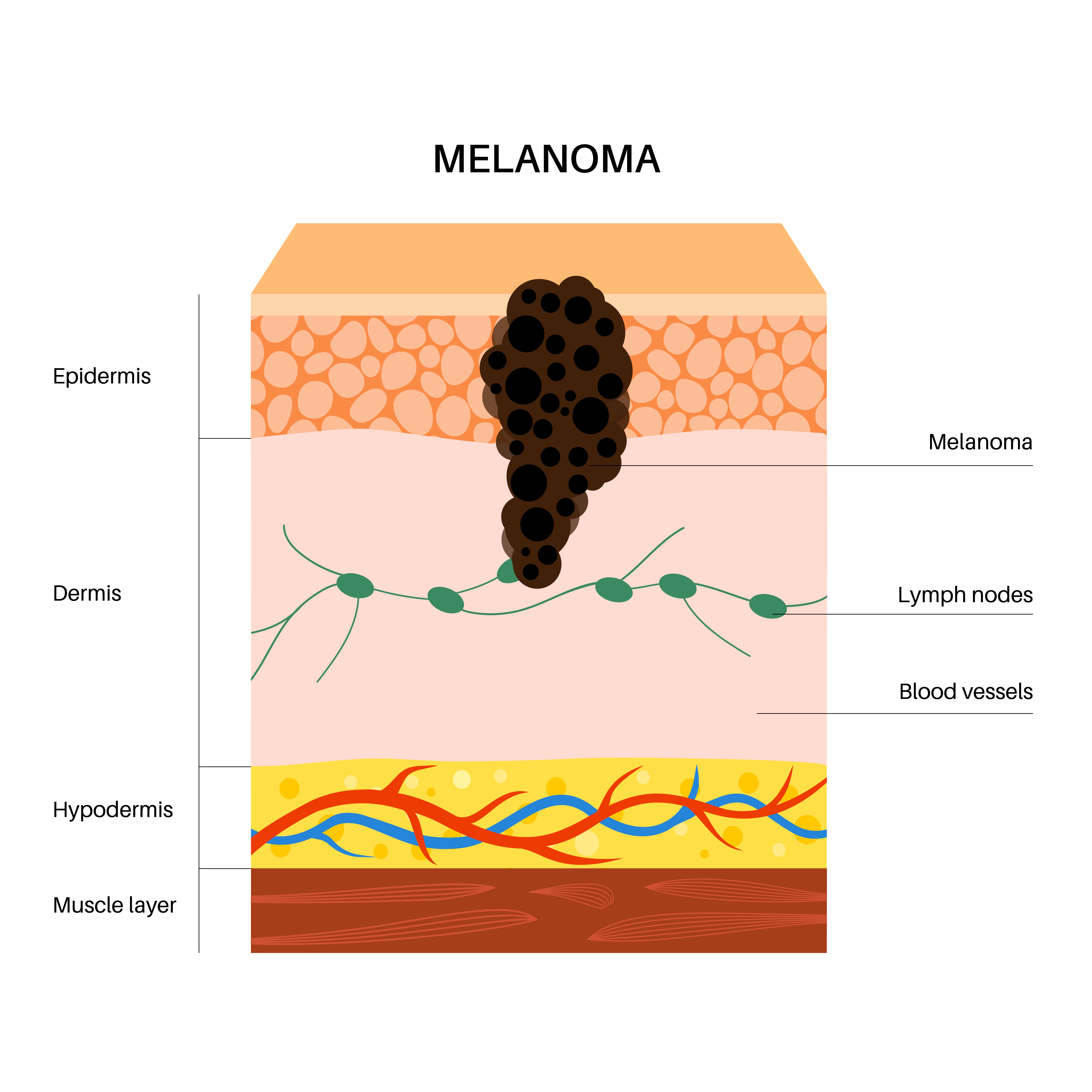 3D vector illustration of different types of skin cancer – medical visualization | Source: Getty Images