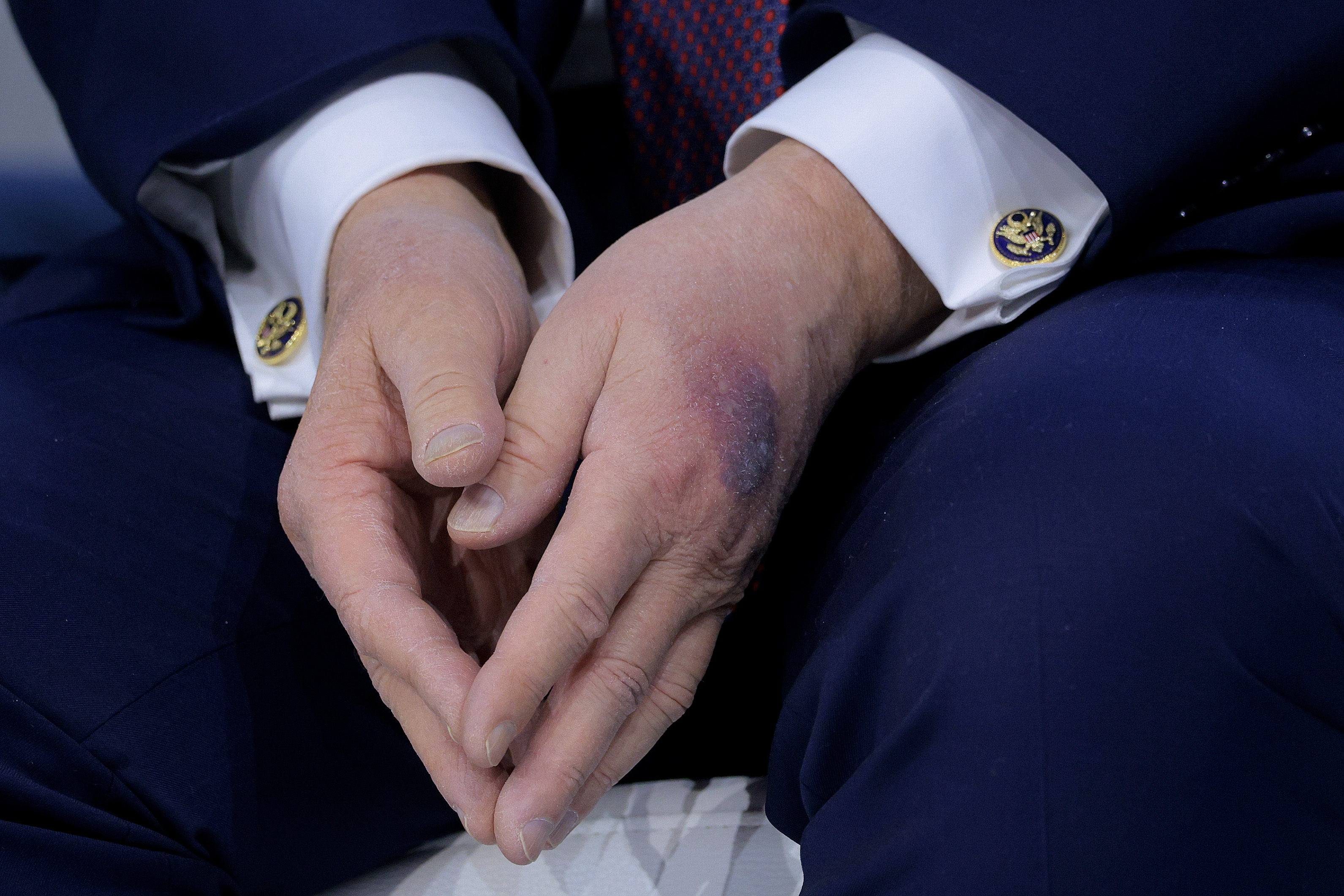 A bruise can be seen on the back of Donald Trump's left hand during a signing ceremony for the “Board of Peace” at the World Economic Forum (WEF) on January 22, 2026 in Davos, Switzerland | Source: Getty Images