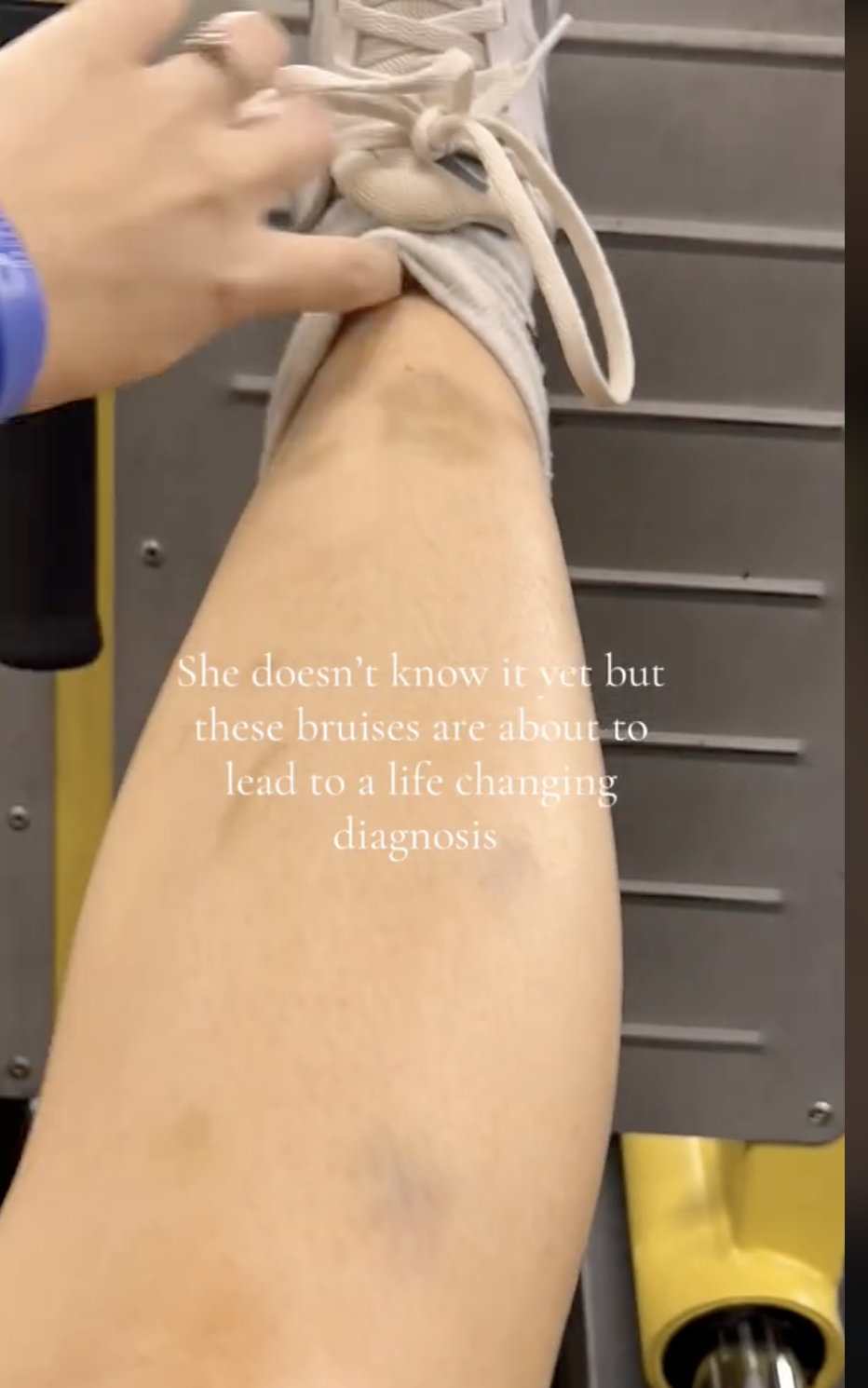 Taylor Omalley's bruised leg as seen in a post dated May 14, 2025 | Source: TikTok/pt_tayloromalley