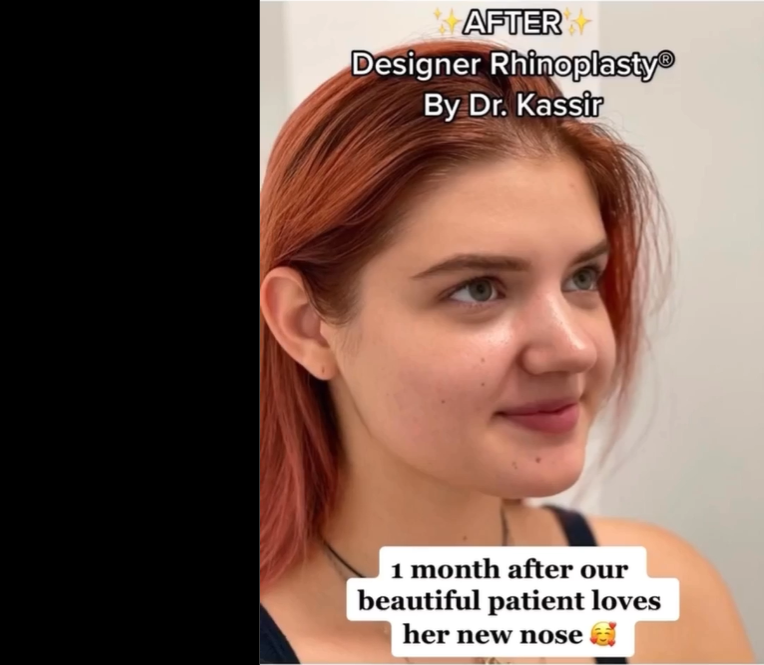 Patient pictured after the procedure, dated September 30, 2022 | Source: Instagram/drkassir
