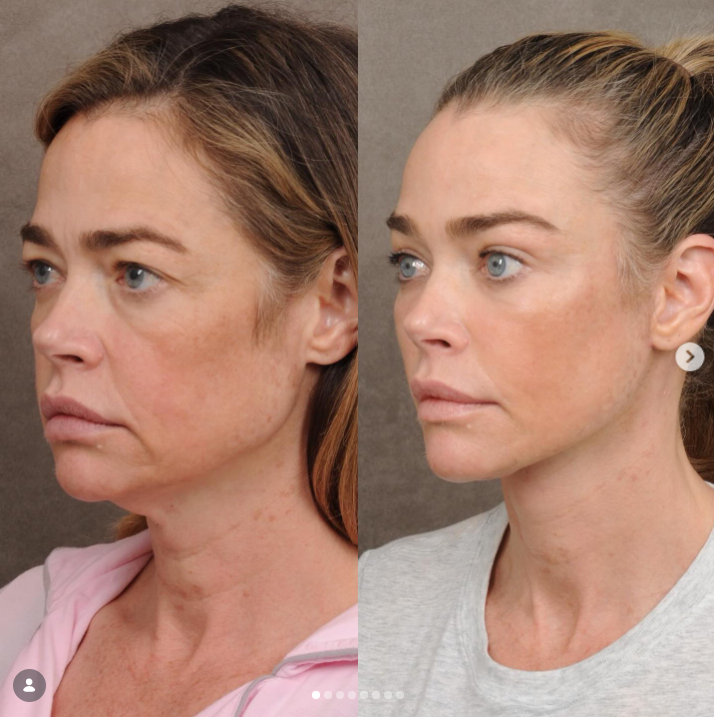 Denise Richards' before and after — Three-quarter (oblique) view | Source: Instagram/drbentalei | deniserichards