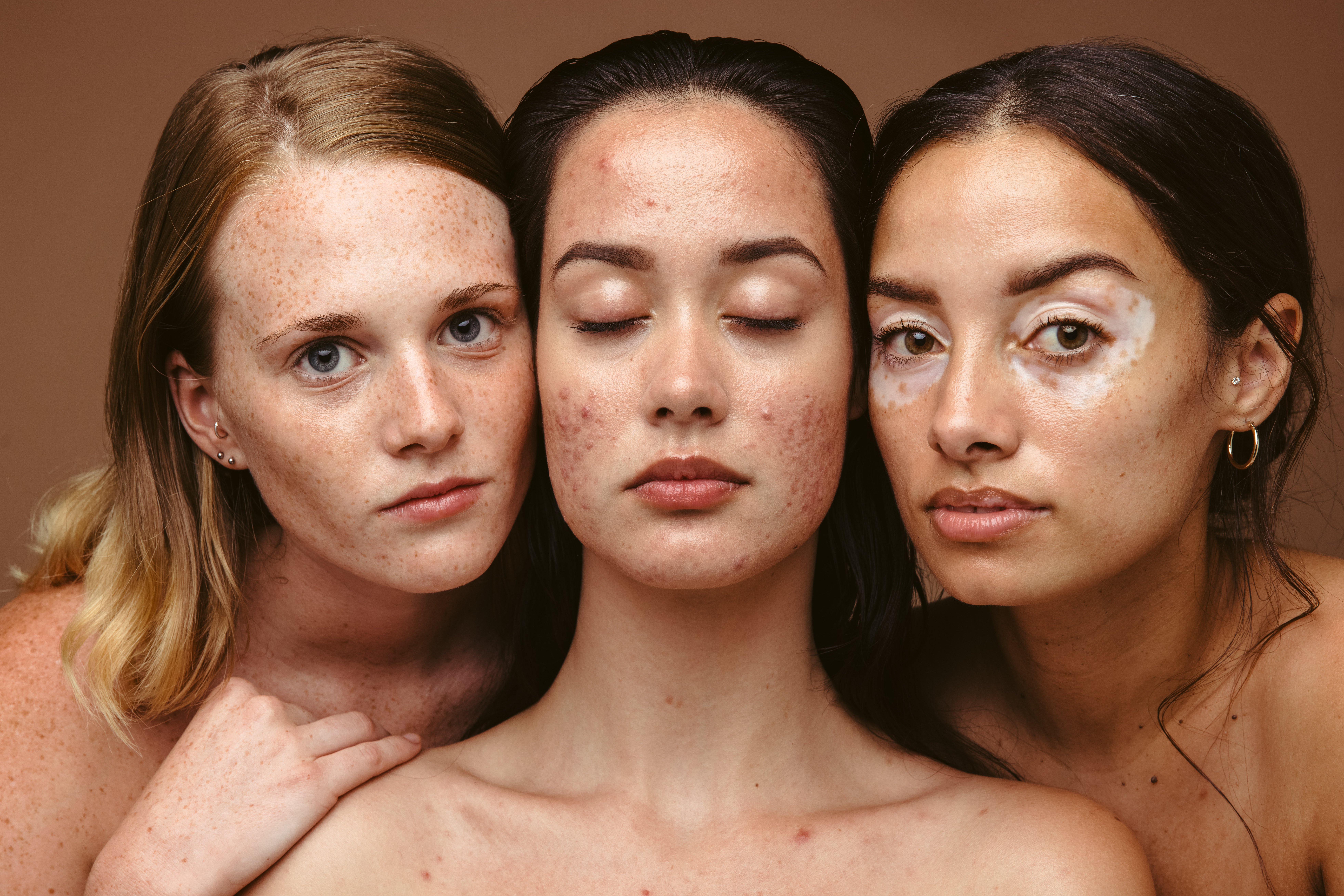 Three models with acne outbreaks. | Source: Shutterstock