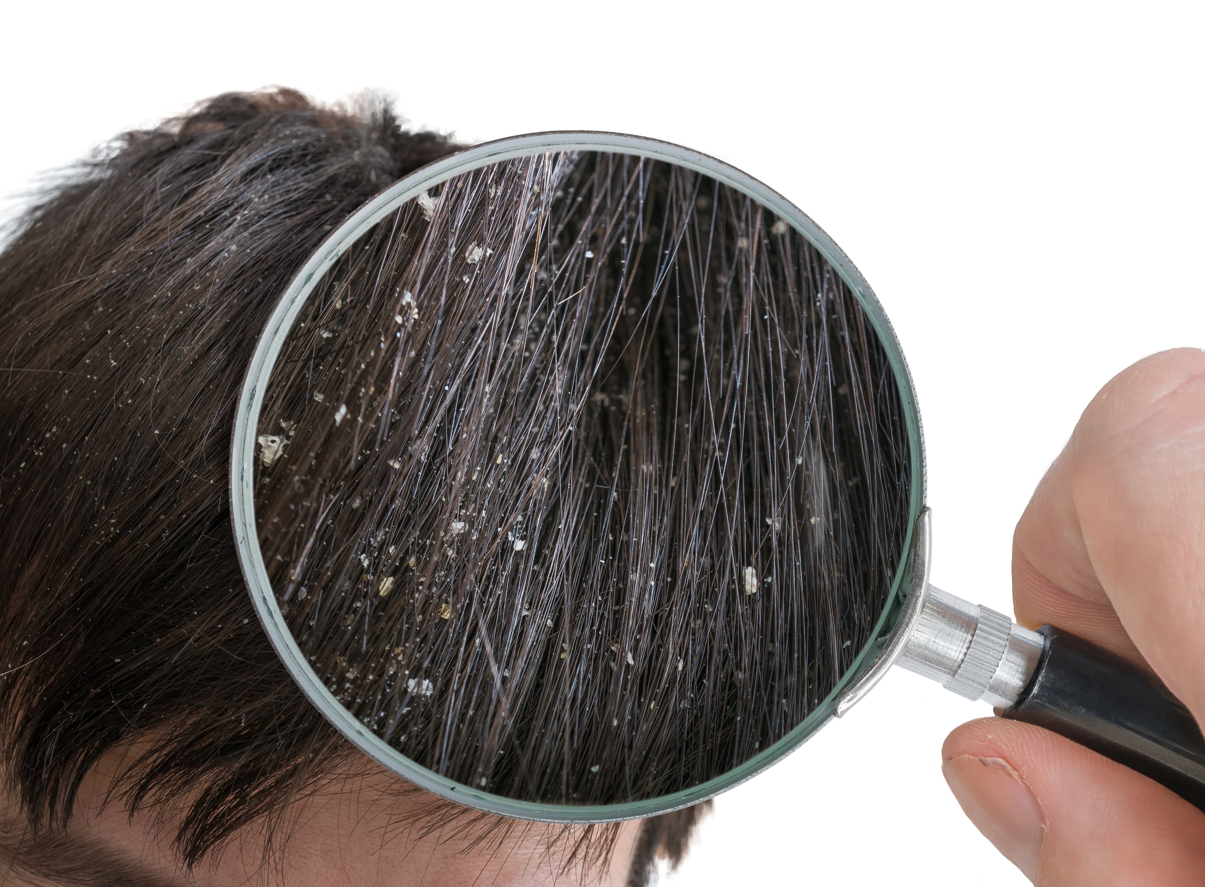 A close look at dandruff flakes in the hair | Source: Getty Images