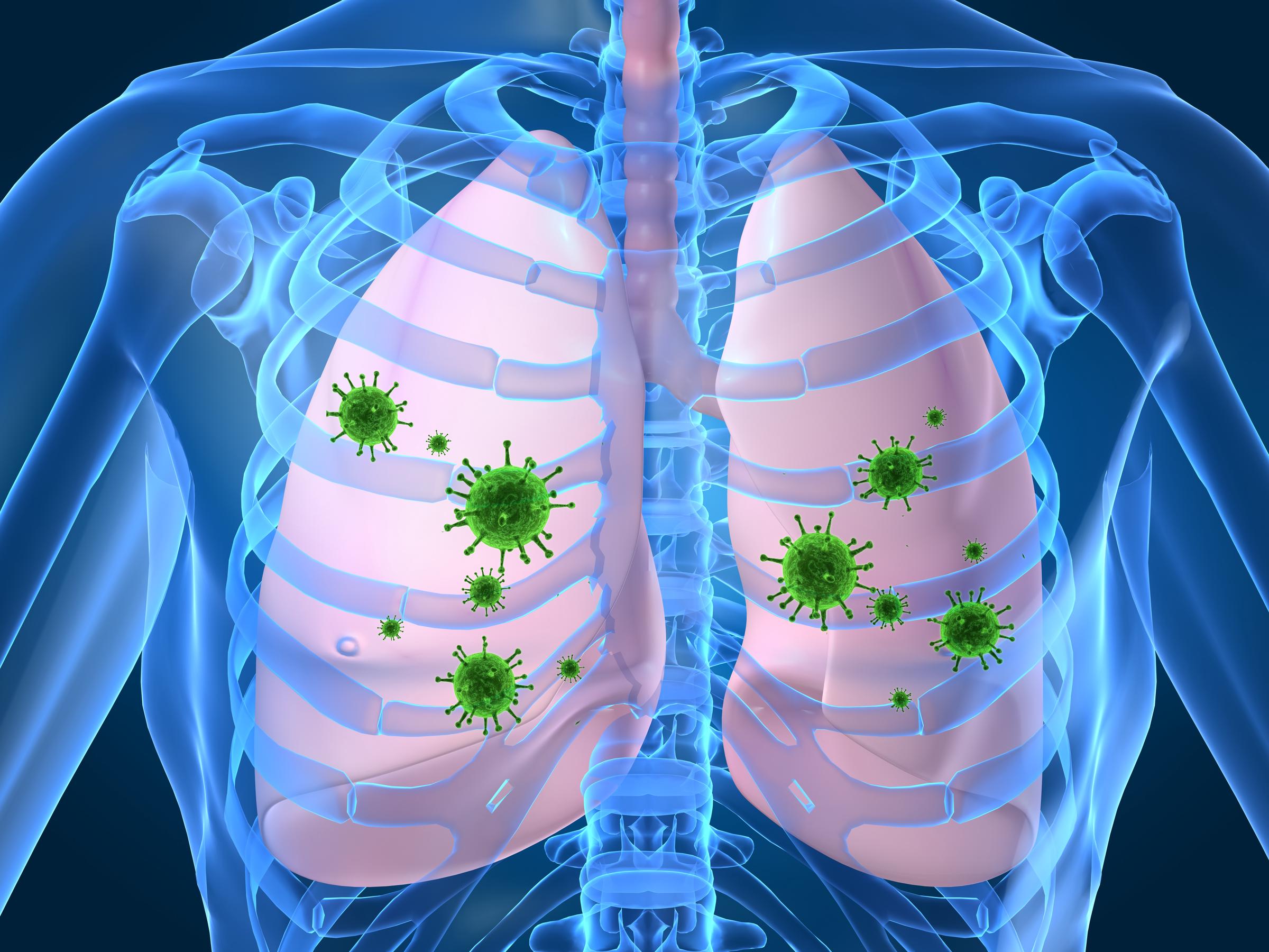 A 3d stock photo illustration of a lung infection | Source: Getty Images