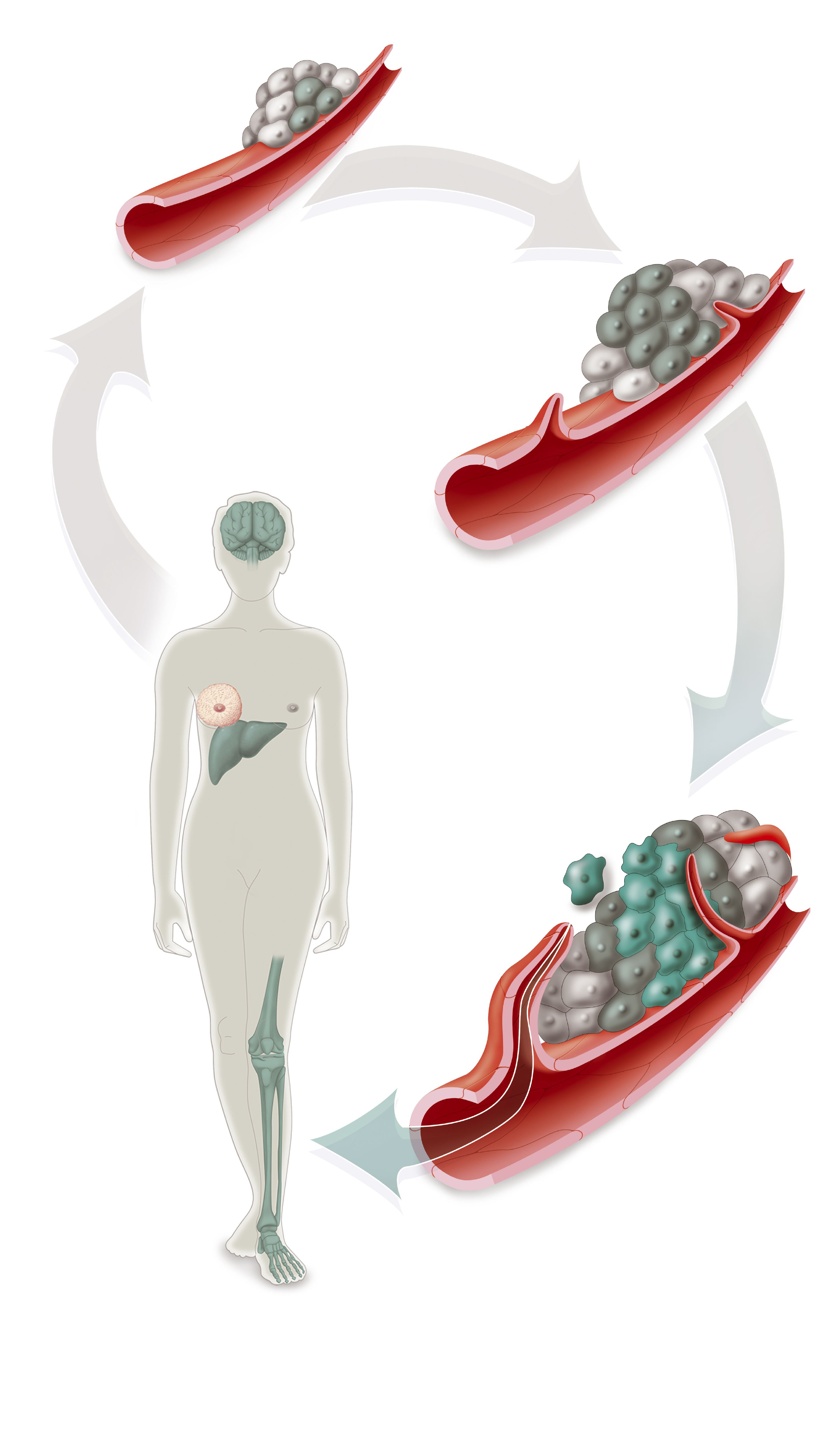 Illustration of the formation of metastases | Source: Getty Images