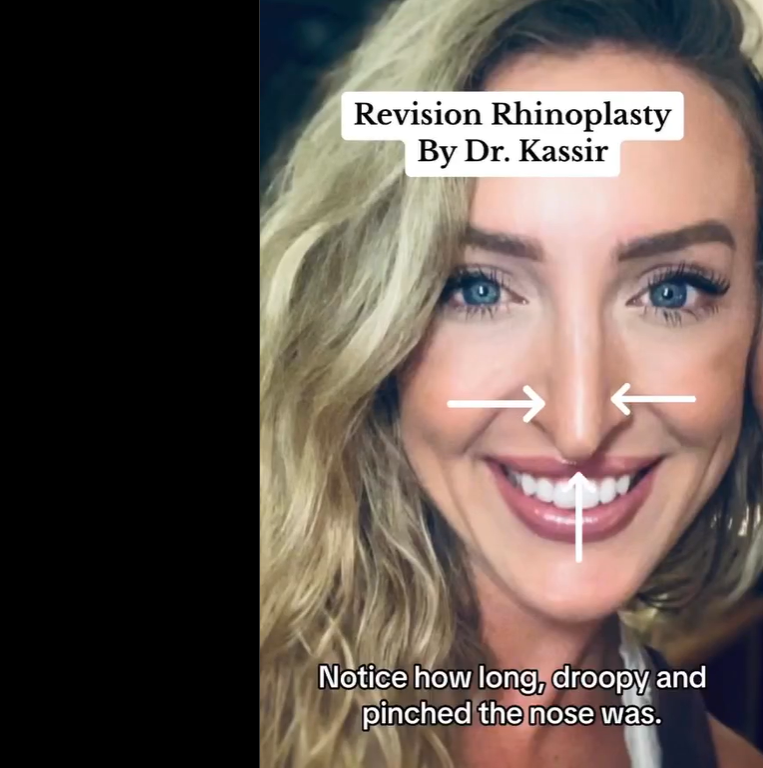 Patient before the procedure, dated August 26, 2023 | Source: Instagram/drkassir