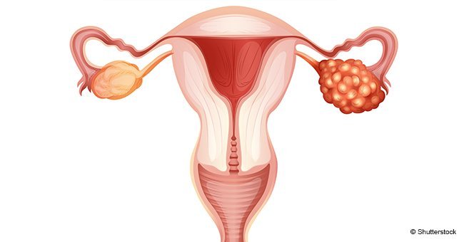 8 early symptoms of ovarian cancer every woman should know about