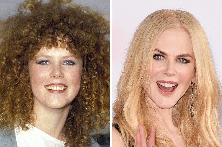 Nicole Kidman avant et après. ǀ Source : Getty Images