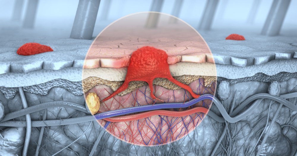 Illustration 3D d'une coupe transversale d'une peau atteinte d'un mélanome qui pénètre dans le sang et les voies lymphatiques. Photo : Shutterstock Illustration 3D d'une coupe transversale d'une peau atteinte d'un mélanome qui pénètre dans le sang et les voies lymphatiques. Photo : Shutterstock