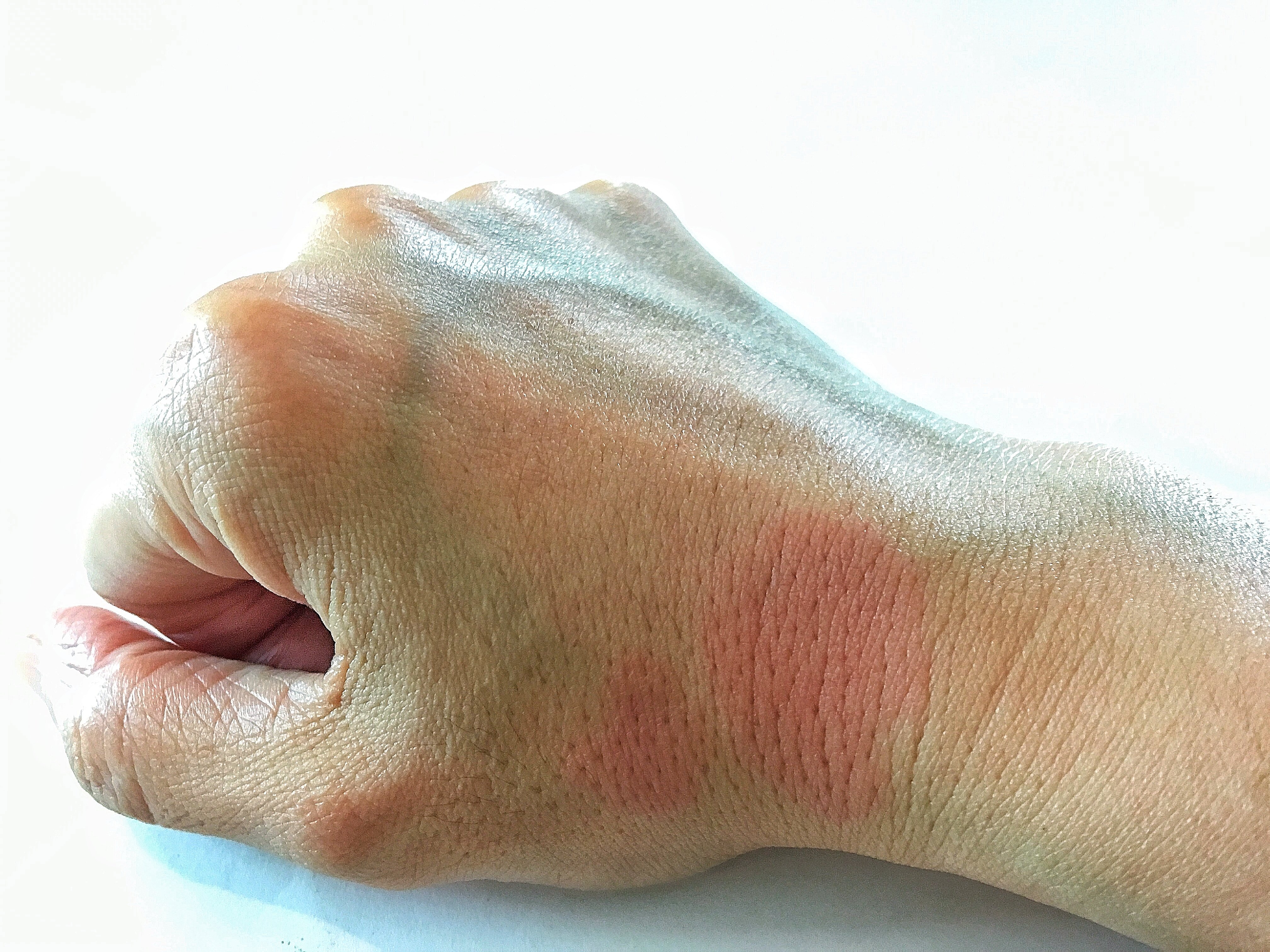 Con el lupus puede aparecer erupción en la cara, el cuello y el cuero cabelludo. | Foto: Getty Con el lupus puede aparecer erupción en la cara, el cuello y el cuero cabelludo. | Foto: Getty