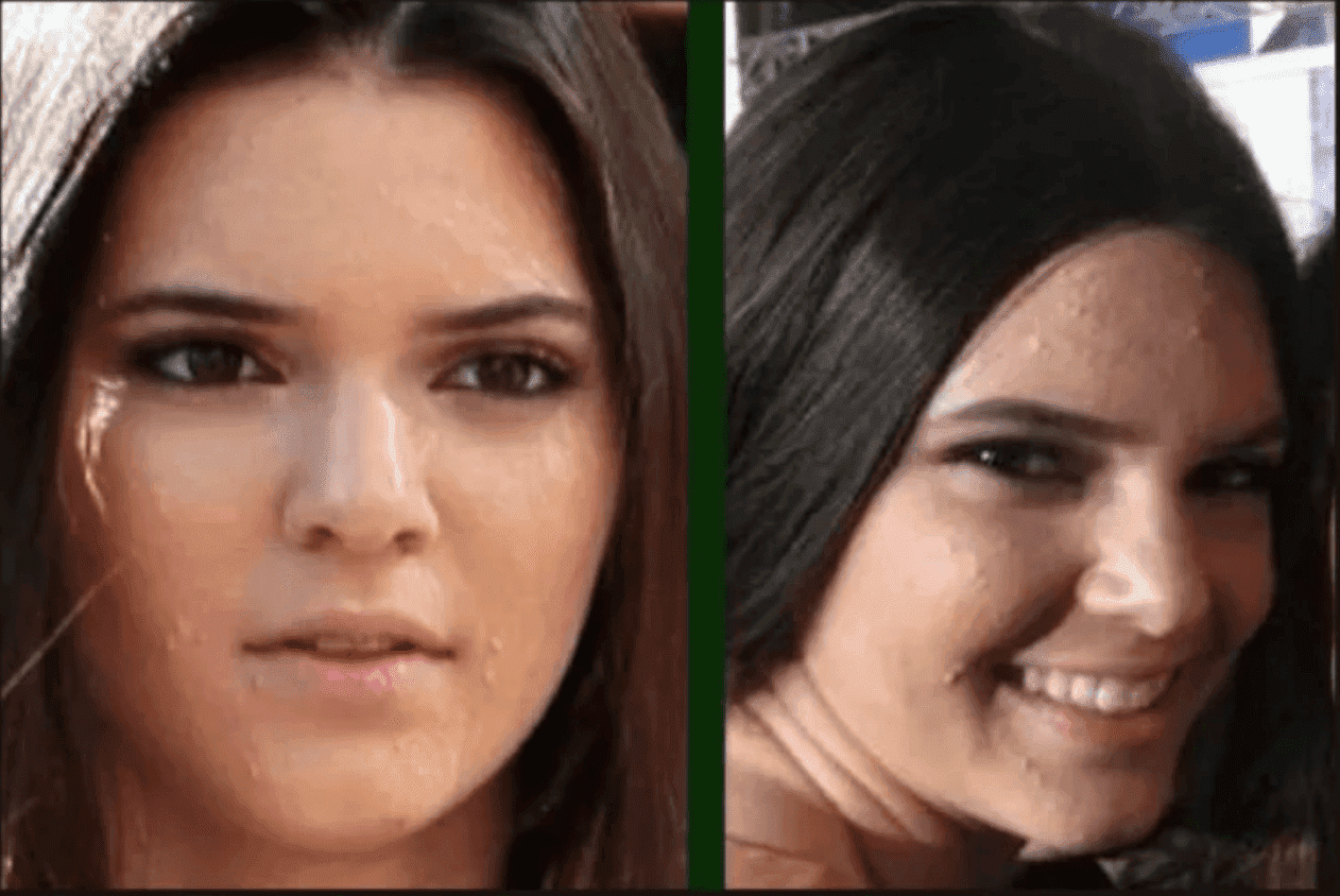13-year-old Kendall's face with acne | Photo: Instagram/kendalljenner